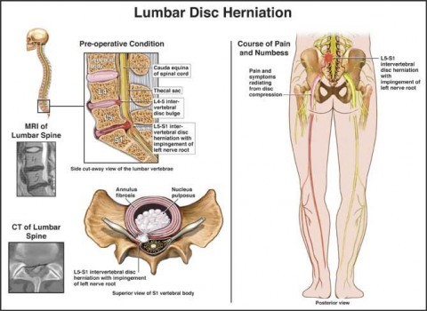 Lumbar Disc Herniation