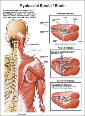 Myofascial Sprain or Strain